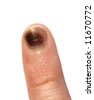 Finger Bruise
